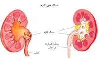 تقسیم بندی افراد از لحاظ لزوم بررسی های کلیوی